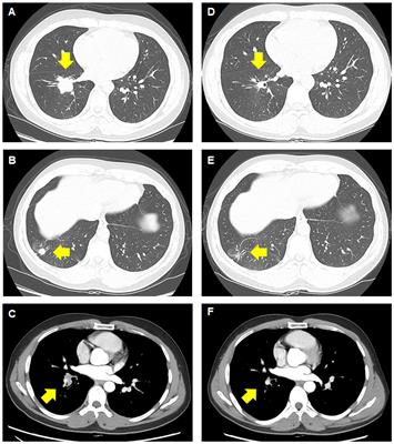 Case report: Pathological complete response to neoadjuvant brigatinib in stage III non-small cell lung cancer with ALK rearrangement
